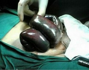 Strangulated Hernia pics