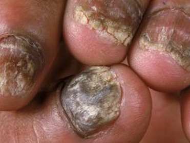Onychomycosis pictures