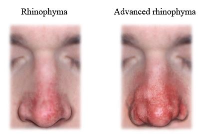 rhinophyma image