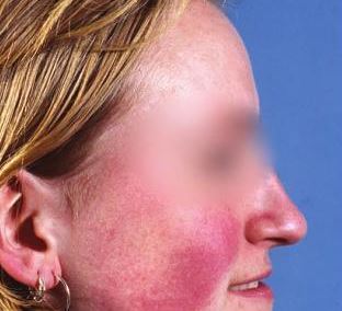 rhinophyma picture