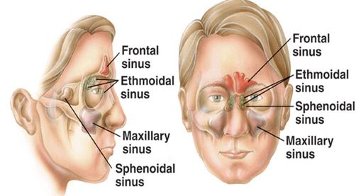 sinus types