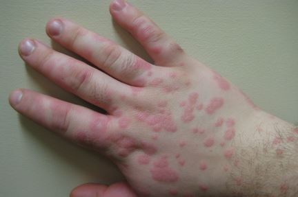 erythema multiforme on hands