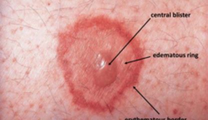 erythema multiforme pic