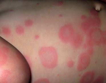 erythema multiforme picture