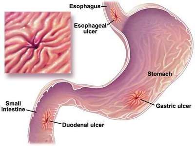 Peptic-ulcers