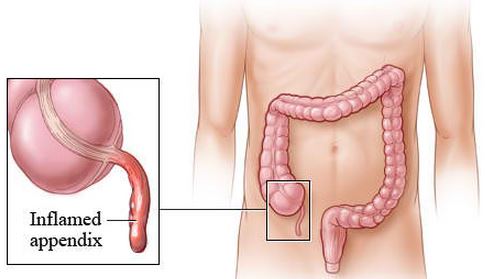 inflamed appendix