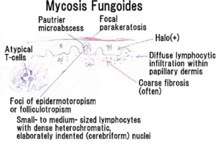 mycosis fungoides symptoms prognosis