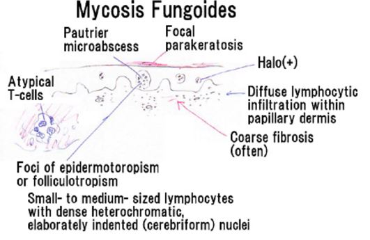 Mycosis fungoides photo