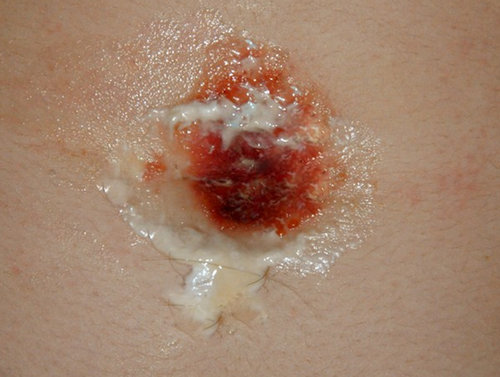 A belly button with stinky discharges.picture