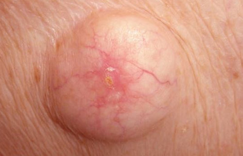 An image of an ingrown hair cyst.picture