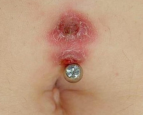 an infected belly button secondary to piercing.photo