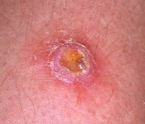 an infected ingrown hair cyst.image