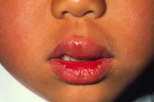 A child with a noticeable swelling of the upper lip.image