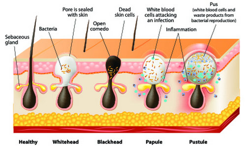 A hair follicle types of pimples.photo