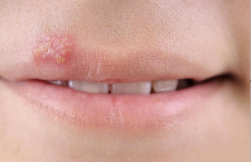 A white spot on the lip secondary to herpes infection.photo