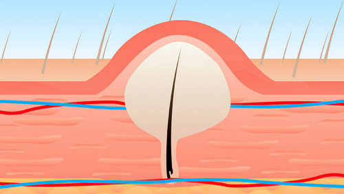 An illustration of ingrown hair.picture