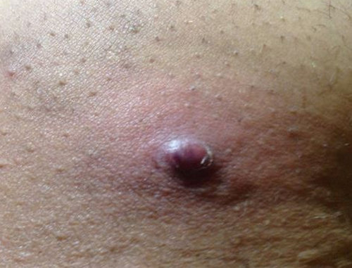 An ingrown hair from after shaving.photo