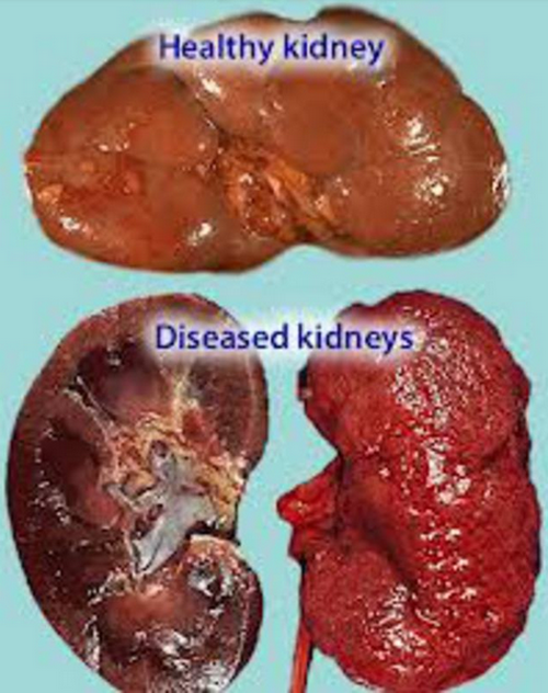 A comparison between a healthy kidney and a diseased kidney.photo